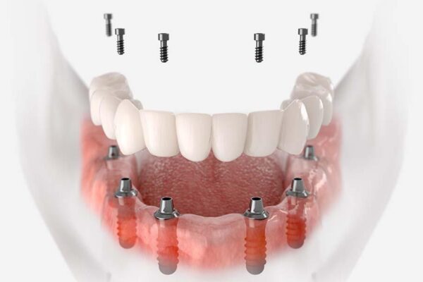 How To Choose The Best Dental Crown For Optimal Function And Aesthetics