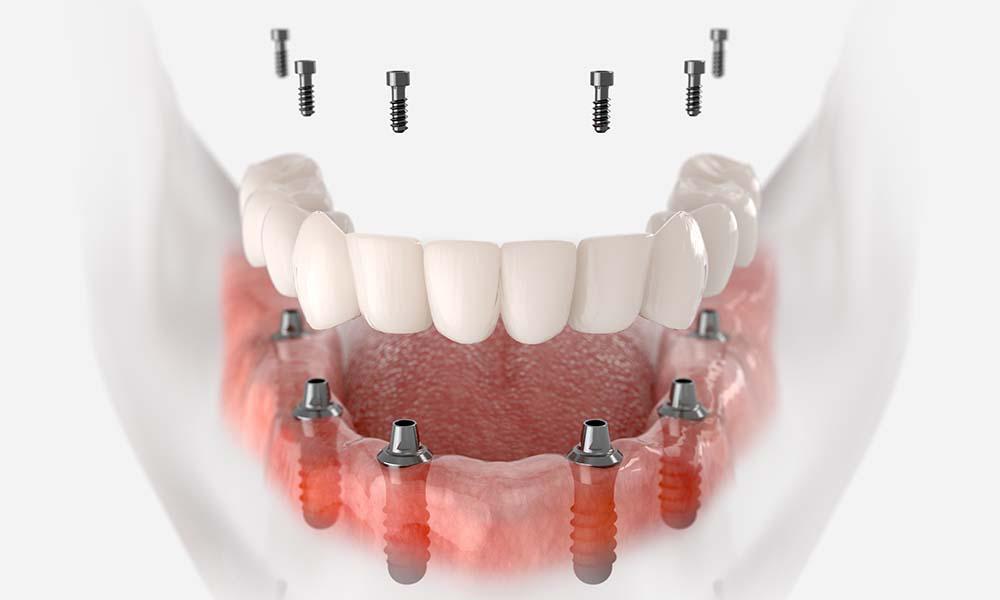 How To Choose The Best Dental Crown For Optimal Function And Aesthetics