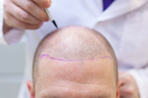 Boosting Confidence And Self-Esteem - Hair Transplant In Turkey