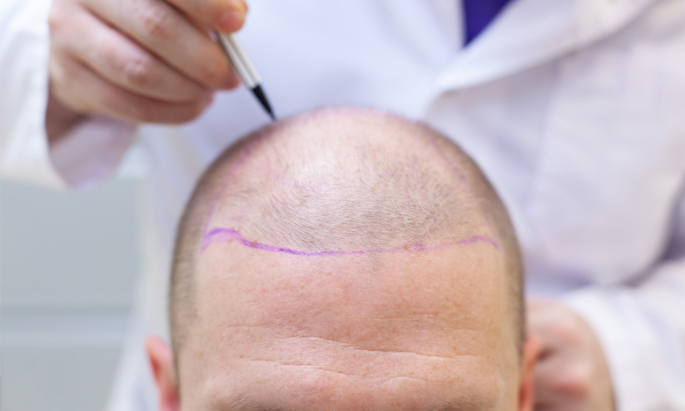 Boosting Confidence And Self-Esteem - Hair Transplant In Turkey