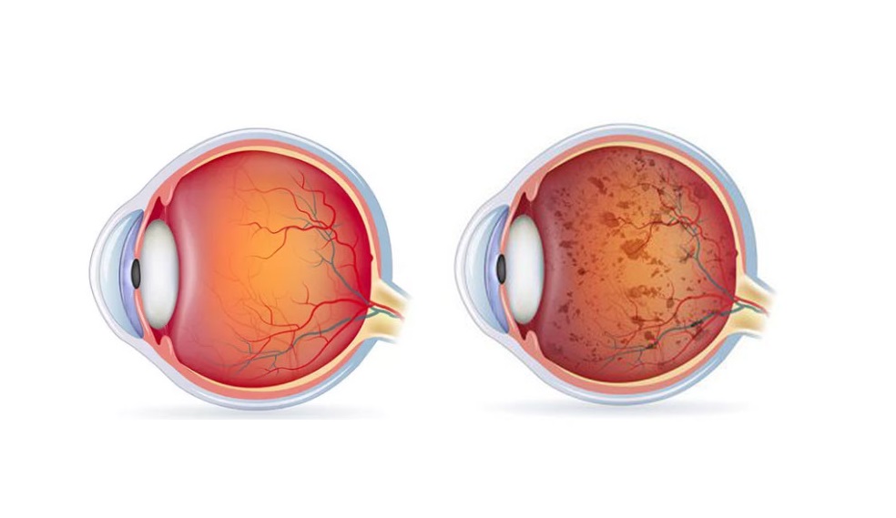 Retinitis Pigmentosa